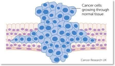 Cancro